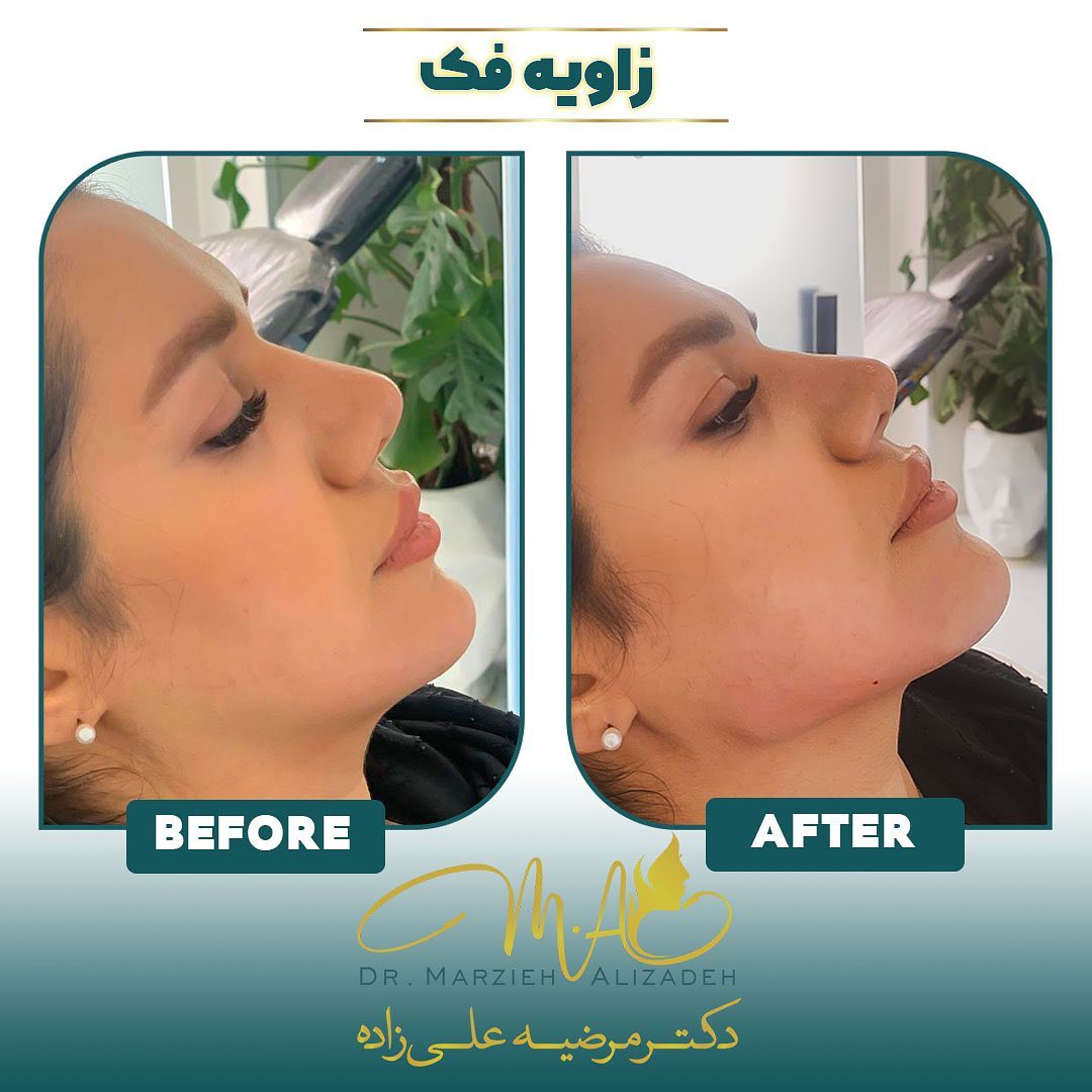 دکتر مرضیه علیزاده   لب روسی  فیلر  بوتاکس  زاویه سازی صورت  زاویه فک  مادلینگ صورت  ژل لب  شهریار  اندیشه  ساکشن غبغب