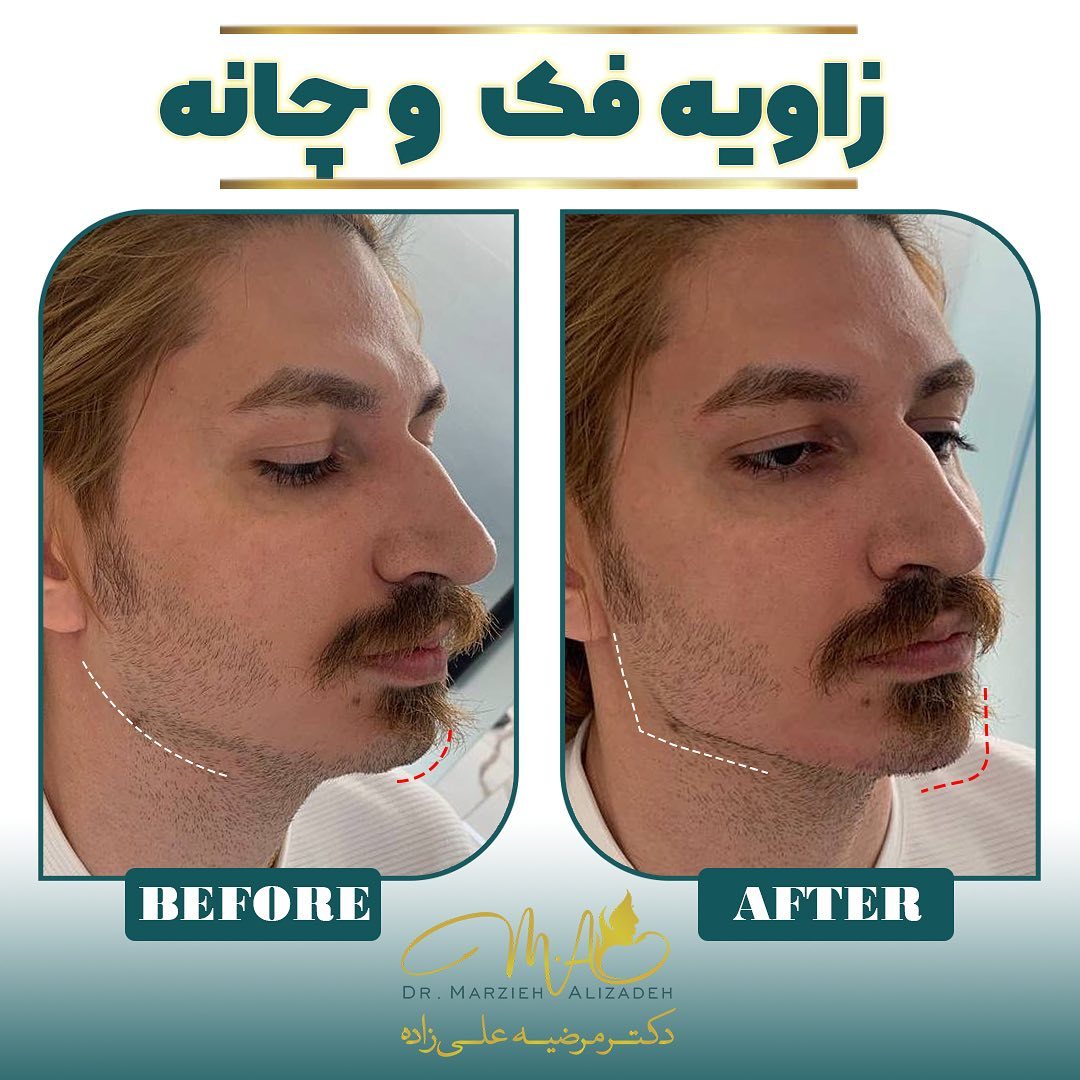 دکتر مرضیه علیزاده  لب روسی  فیلر  بوتاکس  زاویه سازی صورت  زاویه فک  مادلینگ صورت  ژل لب  شهریار  اندیشه  زاویه اقایان  مادلینگ آقایان