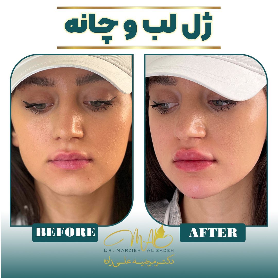 دکتر مرضیه علیزاده  لب روسی فیلر بوتاکس زاویه سازی صورت زاویه فک مادلینگ صورت ژل لب شهریار اندیشه ساکشن غبغب
