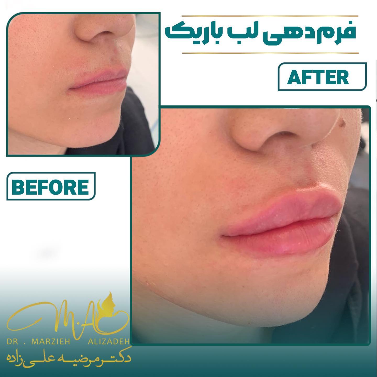 دکتر مرضیه علیزاده فیلر لب روسی  لیفت لب باریک  حجم دهی لب  لبخند زیبا  ژل چانه  prp  پی آر پی  ساکشن غبغب  لاغری موضعی  لاغری سریع